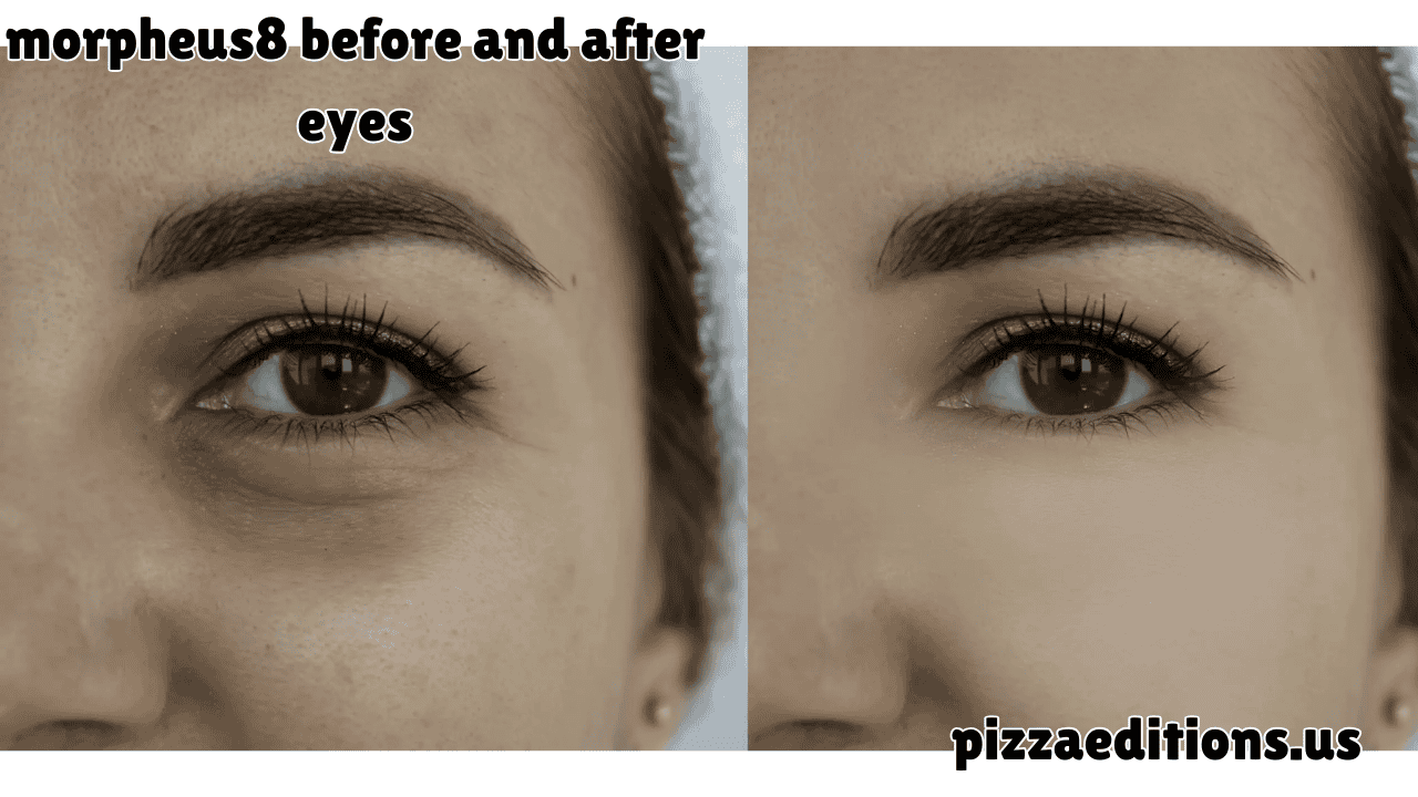 morpheus8 before and after eyes